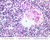 a45 hassall corpuscle medulla infant thymus 40x labeled.jpg