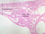 b93 interstitial uterine tube 2x labeled.jpg